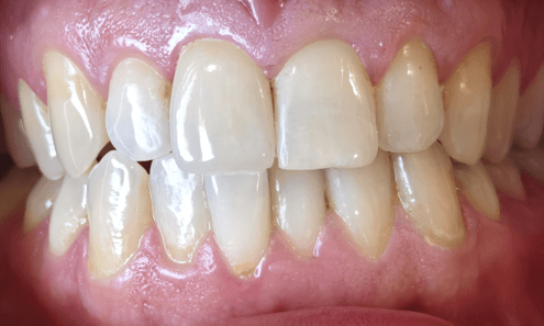Full-Ceramic-Crown-Dental-Restoration-After-Image