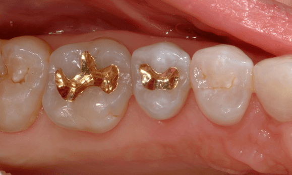 Replace-Old-Dental-Fillings-After-Image