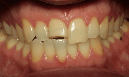 Full-Ceramic-Crown-Dental-Restoration-Before-Image