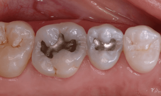 Replace-Old-Dental-Fillings-Before-Image